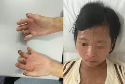 皮肤硬化症是怎么得来的,皮下组织萎缩皮肤硬化