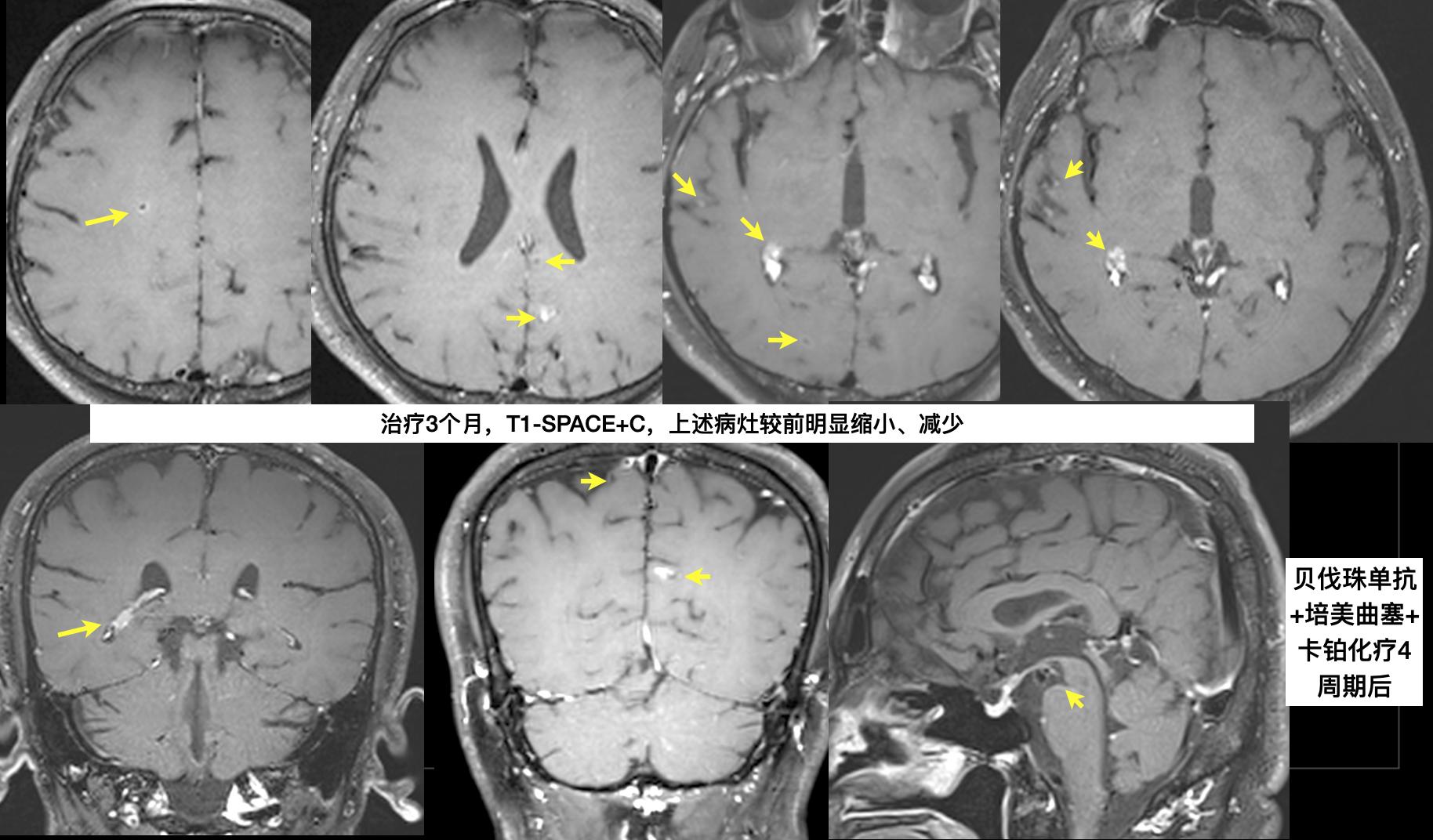 分享一个肺癌脑转移病例