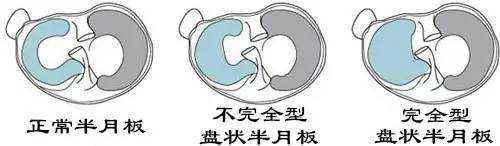 如何保护膝关节半月板,保护半月板的运动护具