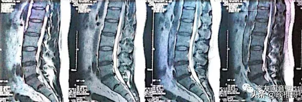 椎间孔镜康复历程,椎间孔镜手术从哪年开始