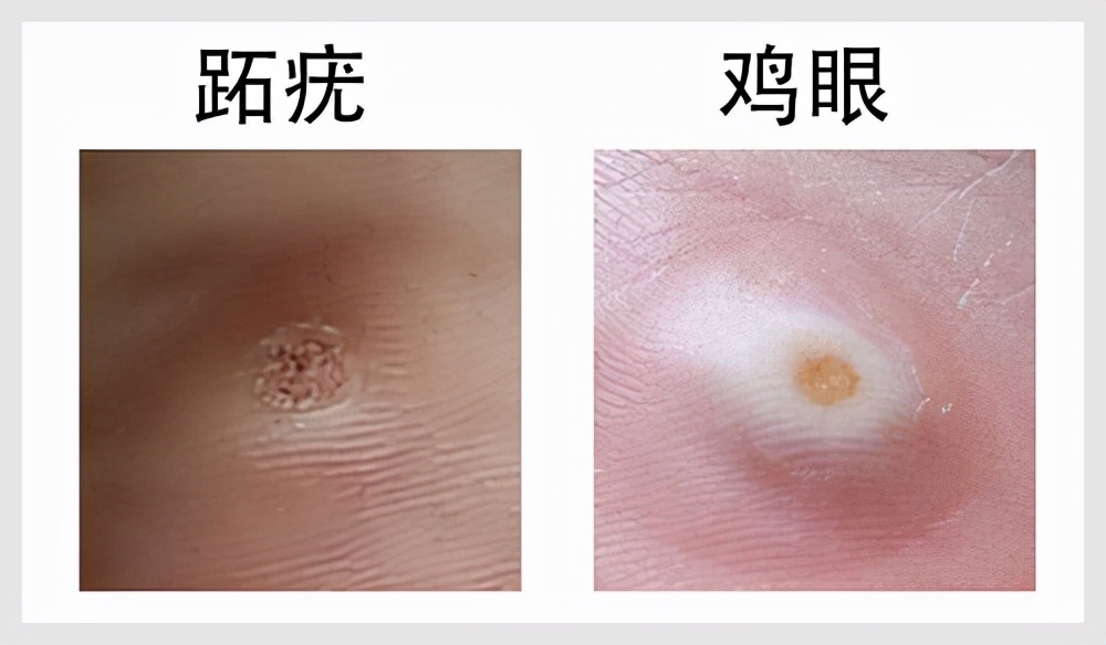 脚上的跖疣是瘊子吗,跖疣和刺瘊怎么感染的