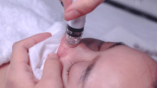 做了小气泡毛孔变大了怎么办,脸部做完小气泡清洁后毛孔变大