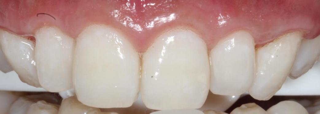 如何让牙齿变白最简单的方法,想要牙齿变白来试试这三种方法