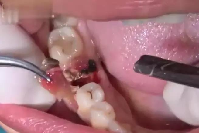 盘点那些看着都很疼的拔牙方法,拔牙过程的操作步骤及注意事项