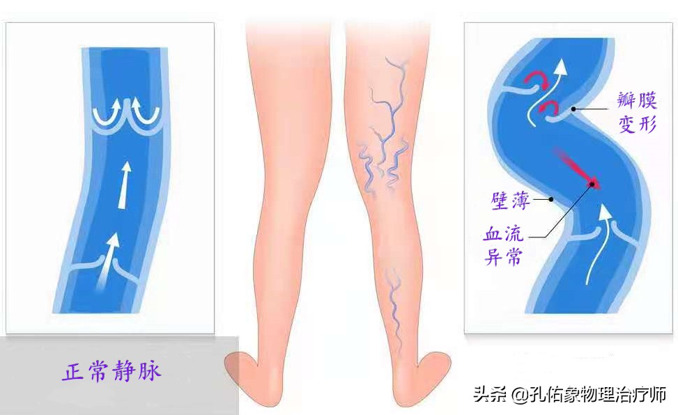 腿上细血管像蜘蛛样怎么回事,小腿上的血管像小蚯蚓一样