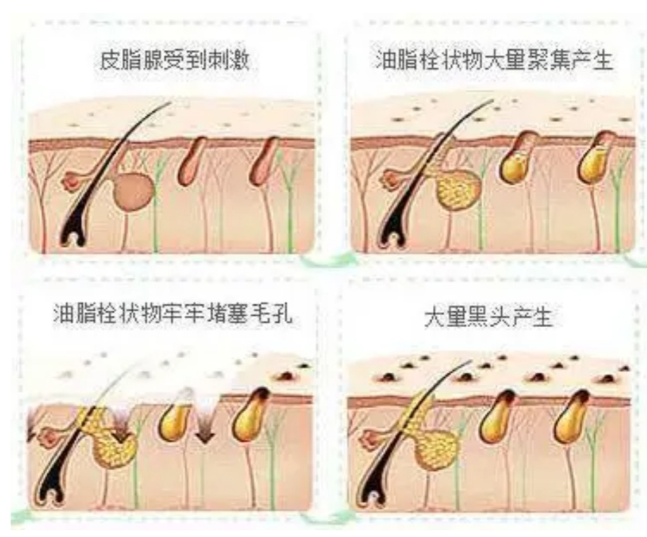 皮脂腺怎么处理,皮脂腺大怎么办