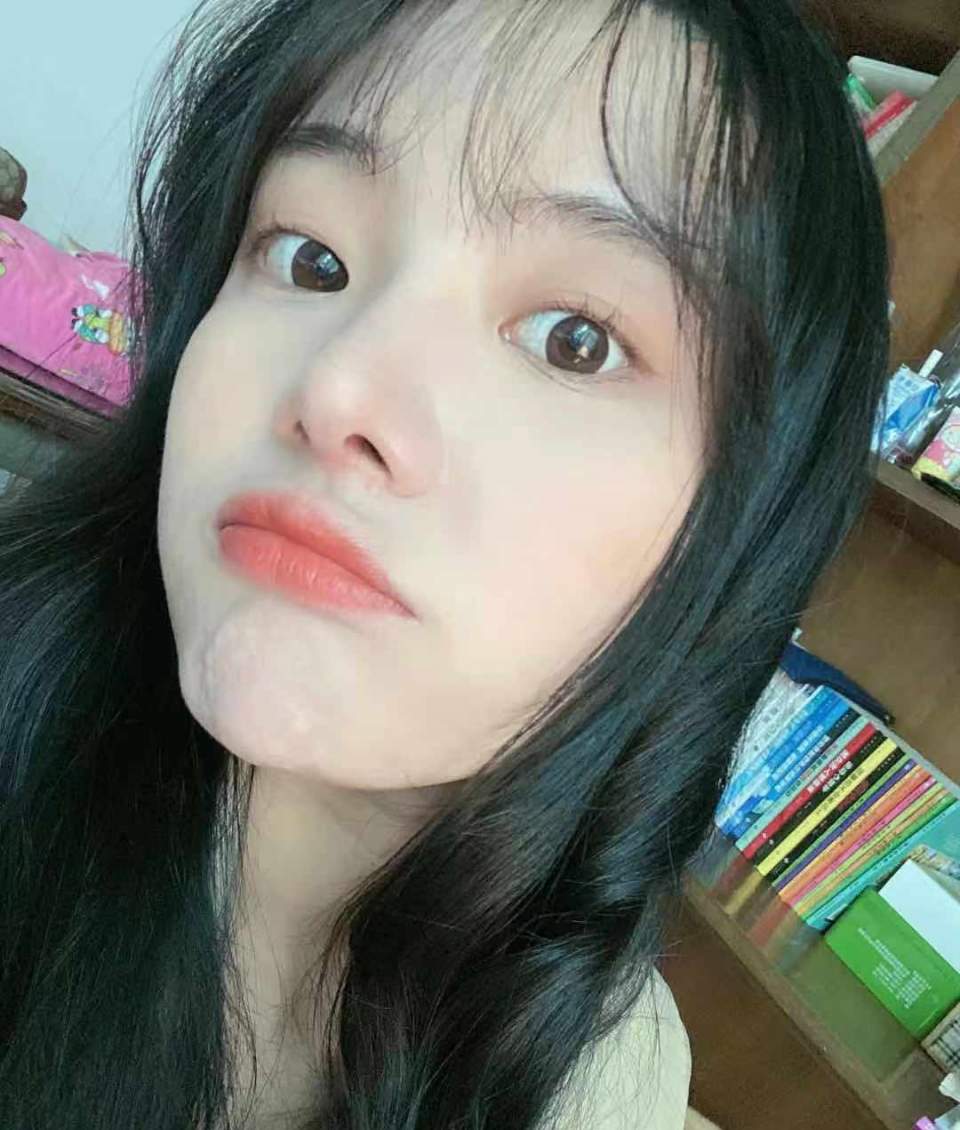 网红鼻子修复效果图,鼻整形多久可以修复