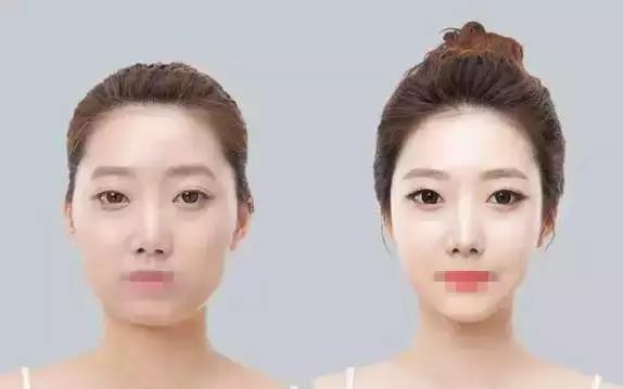 你知道什么是玻尿酸吗,如何快速了解玻尿酸品类