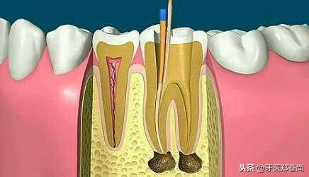 根管治疗再治蛀牙,根管治疗后蛀牙怎么补救