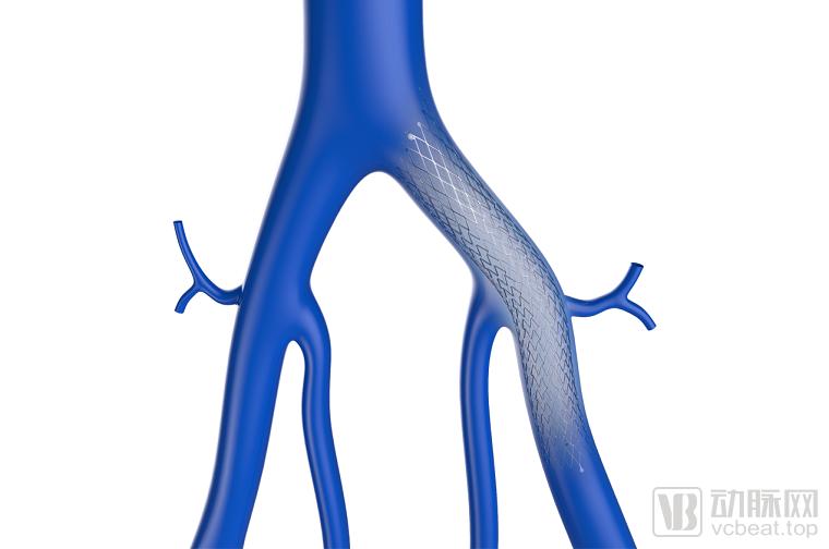2019年中国血管介入类市场规模,外周血管介入市场规模