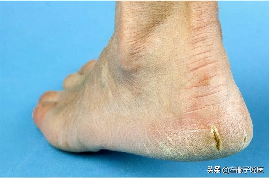 冬天一到脚后跟开裂,老年人冬天脚后跟开裂怎么办