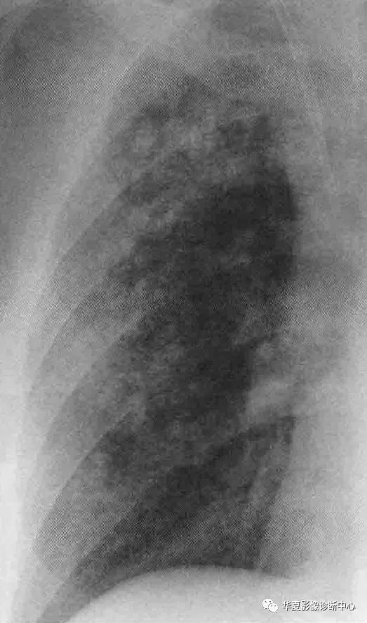 肺部代谢周期是多少天,肺部高代谢病变