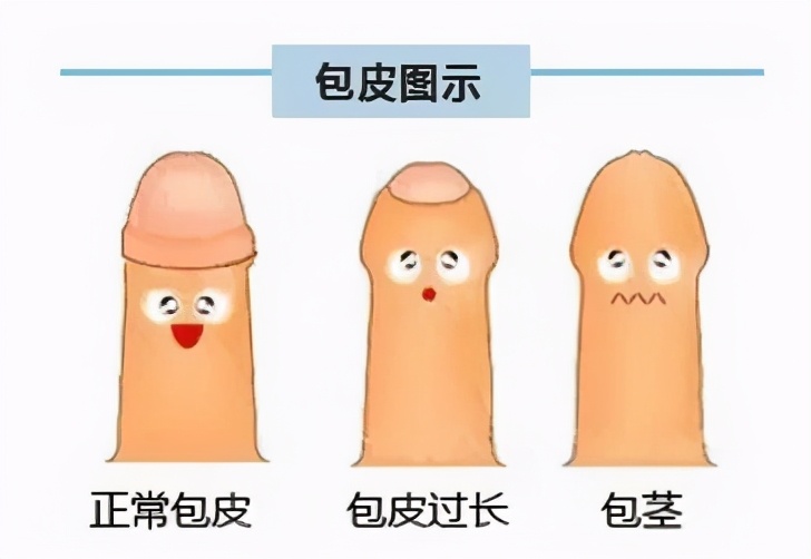 有关孩子小鸡鸡的几种常见问题，都在这里了