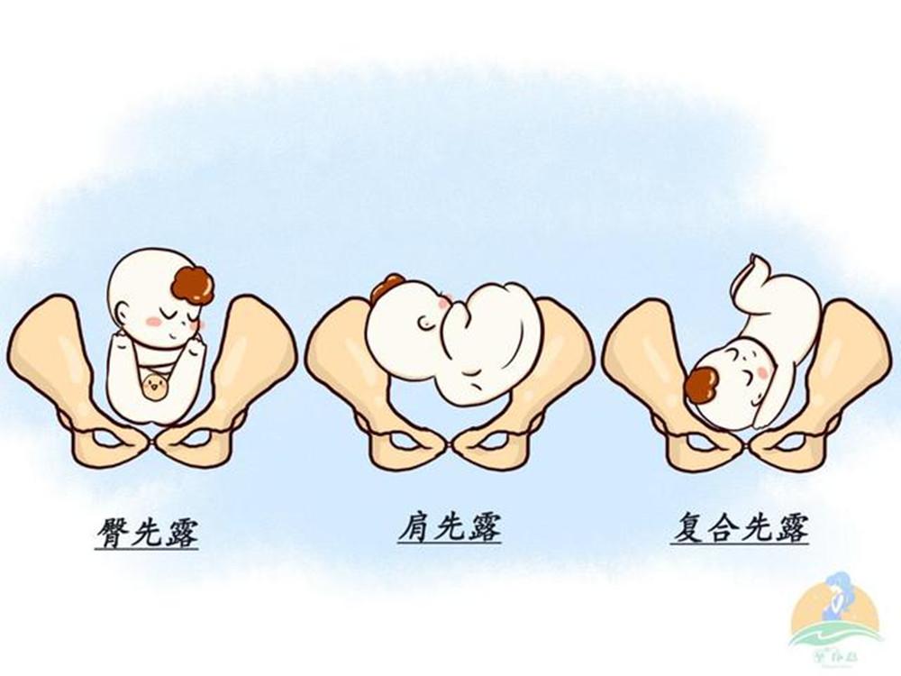 胎位不正怎么纠正最快注意事项,胎位不正怎么纠正最快海南