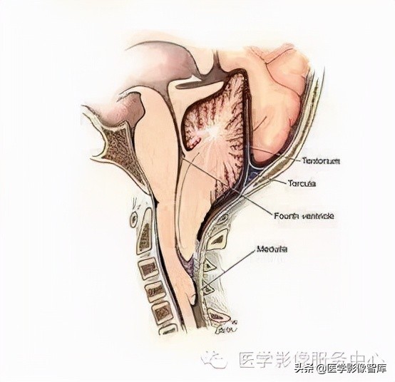 chiari畸形确诊,chiari畸形症状会一直有吗