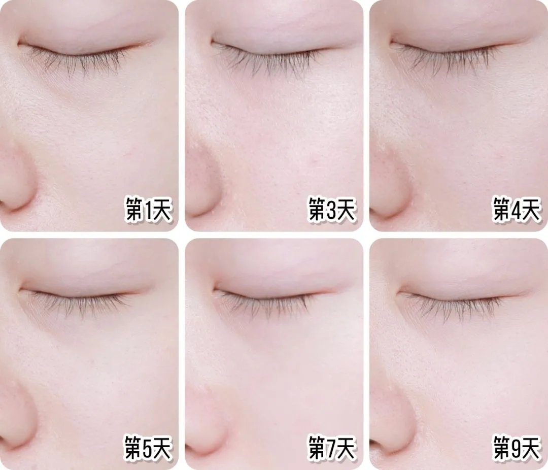 光子和超光子有什么区别,超光子比光子嫩肤贵吗