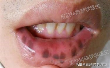 如何治疗脸上褐青色痣样斑,什么是褐青痣斑