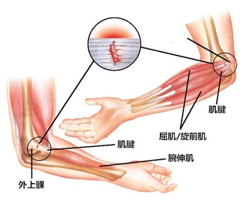 右胳膊上臂疼痛,胳膊游走性疼痛