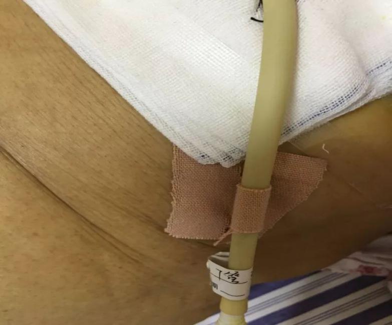 胆管切除后t管脱出怎么办,胆管手术t管脱落有什么症状