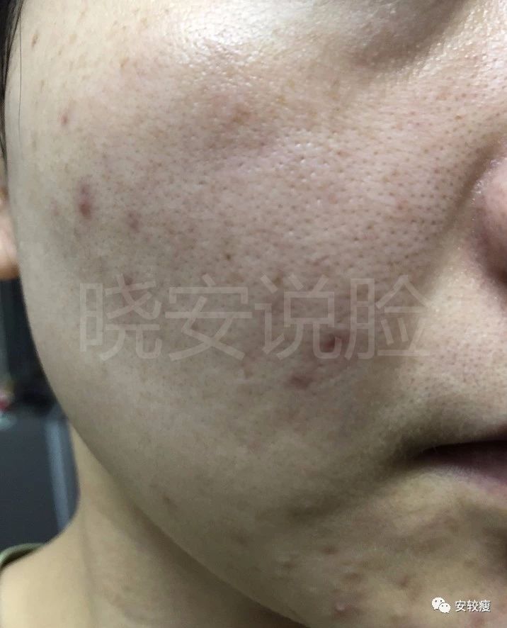 外油内干敏感痘肌怎么护肤,30岁油皮痘痘敏感肌怎么改善