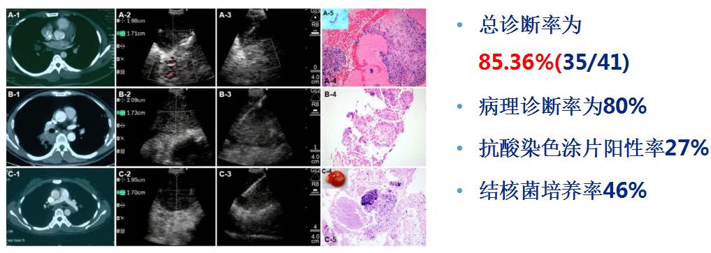 支气管镜高频电刀治疗中央型肺癌,支气管镜在早期肺癌诊断的意义