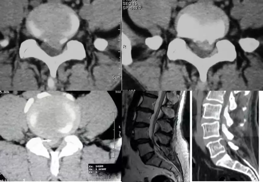 颈椎腰椎疾病ct及mri诊断,腰椎ct可以发现肠部病变吗