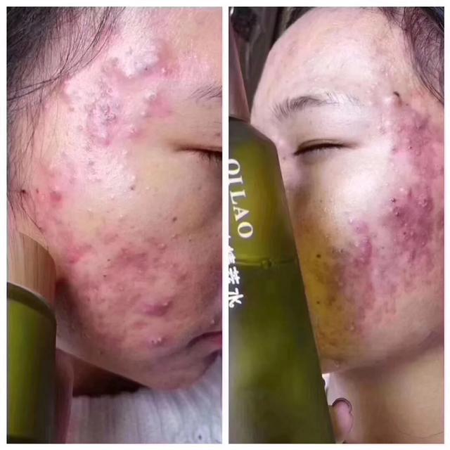 七老修复激素脸是真的假的,七老真的能修复激素脸吗