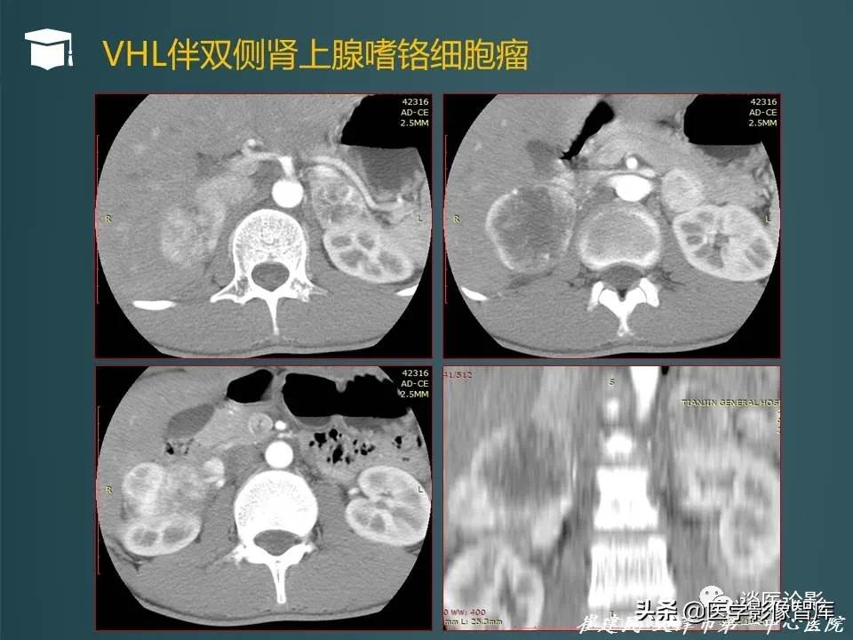 左侧肾上腺结节考虑腺瘤与增生,双侧肾上腺增生是什么原因造成的