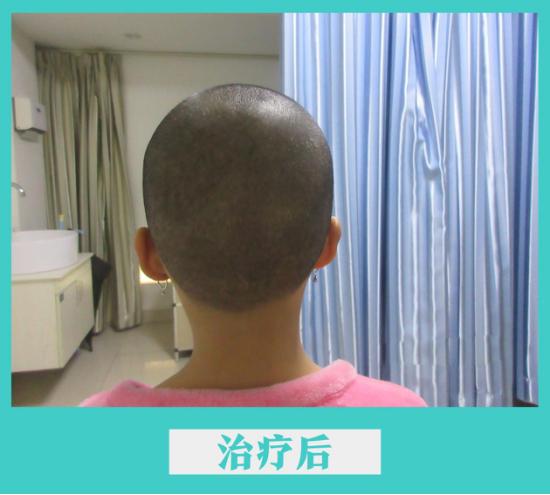 小女孩得白斑要注意什么,小女孩患有罕见疾病