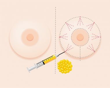 澄清隆胸传闻,辟谣隆胸真的假的