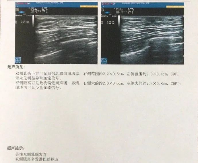 26岁小伙增肌健身,男子健身一年胸肌“暴长”