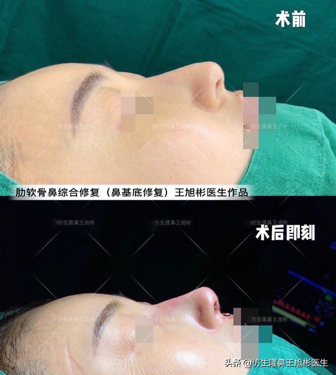 大鼻头能做直鼻微翘吗,可以只做鼻头缩小术吗