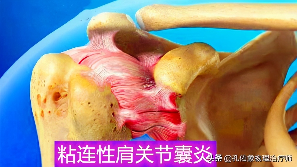 老年人肩周疼痛的厉害怎么治疗,老年人肩背部疼痛怎么回事