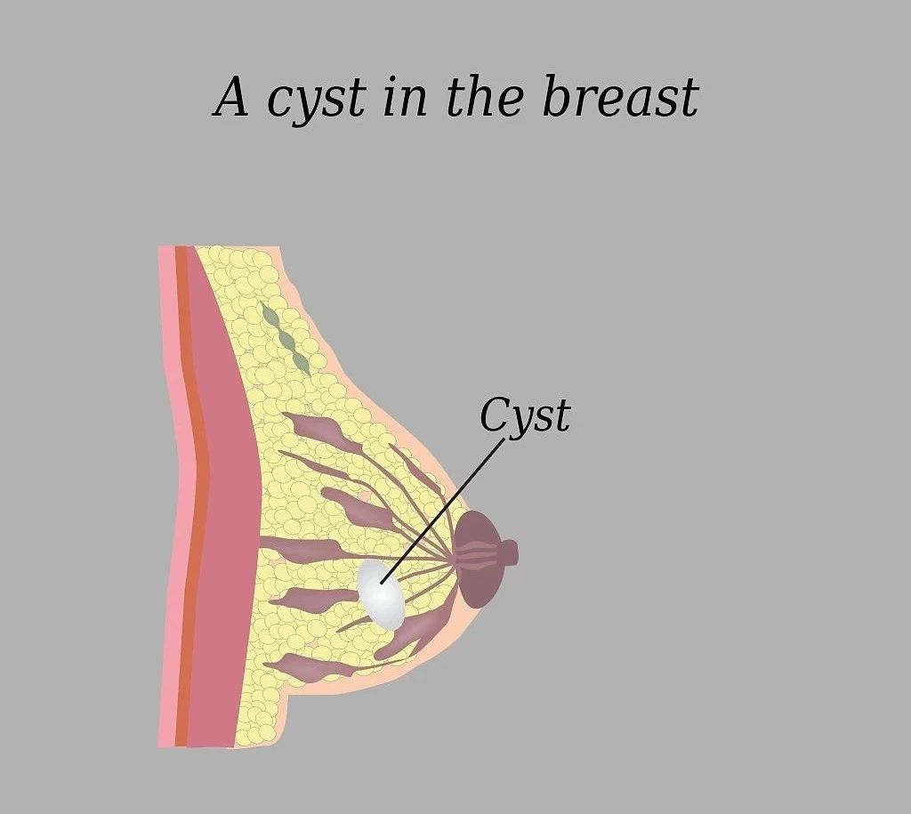 乳房里有水泡是囊肿吗,乳腺增生乳房有囊肿怎么治疗
