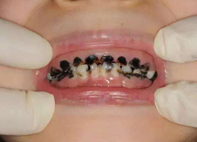 宝宝牙齿不整齐与喝奶嘴有关系吗,两周半的宝宝牙齿烂了掉落