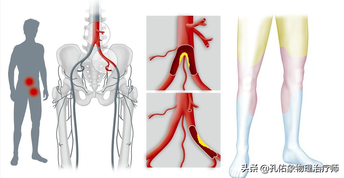 老年人腿脚无力要怎么避免,专治老年人下肢无力的方法