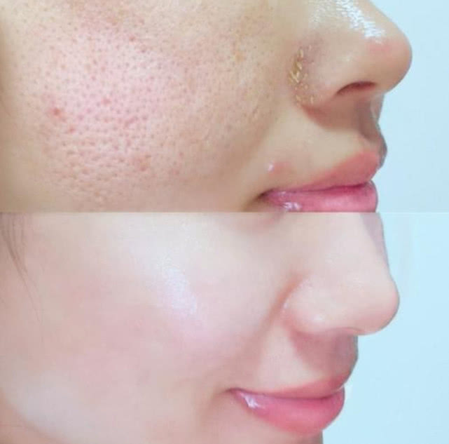 鼻子挤出黄米粒怎么解决,鼻子上有小洞能挤出很多东西