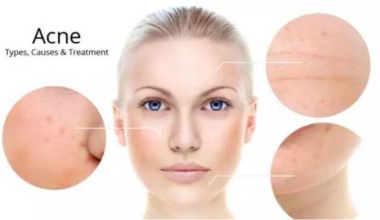 女生闭口痘痘怎么处理好得快,女生脸上有闭口痘痘怎么解决