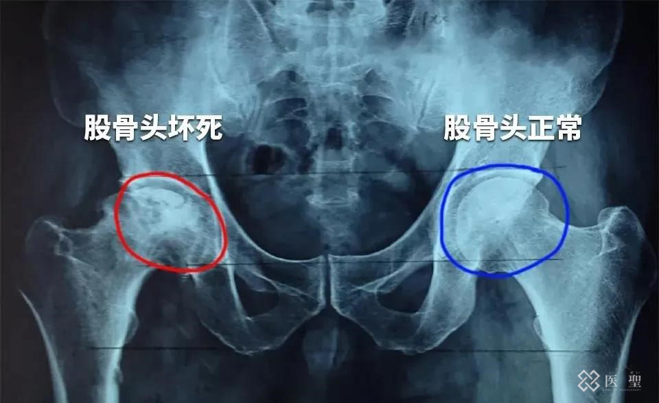 干细胞回输能治疗股骨头坏死吗,造血干细胞治疗股骨头坏死
