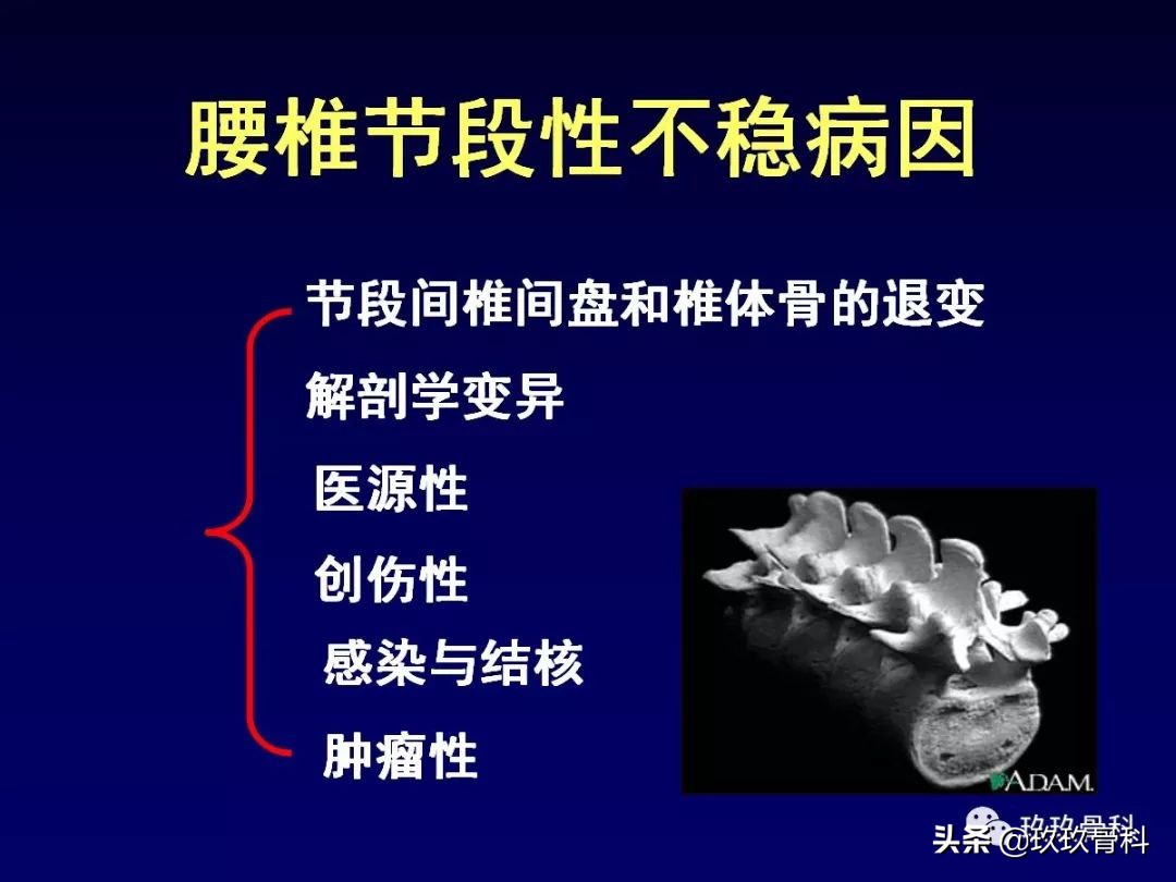 腰椎不稳最坏的结果,腰椎不稳的最佳治疗方法