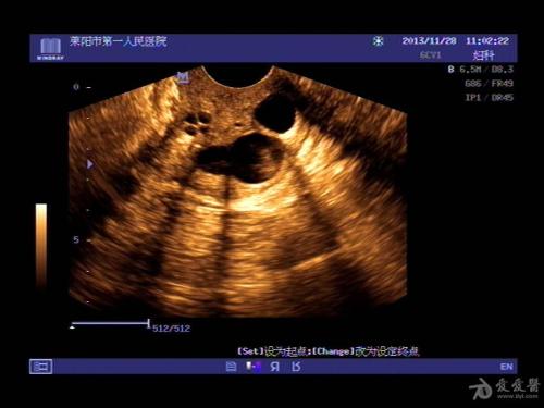 未婚得宫颈巧克力囊肿吗,未婚宫颈囊肿是什么原因引起的啊