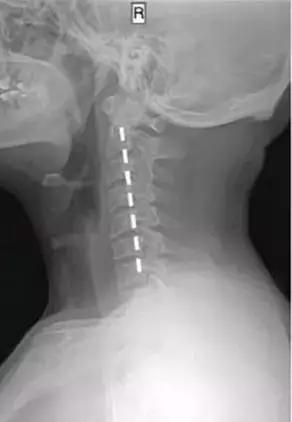 手臂发麻又酸痛是怎么回事,手臂总感觉发麻是什么原因