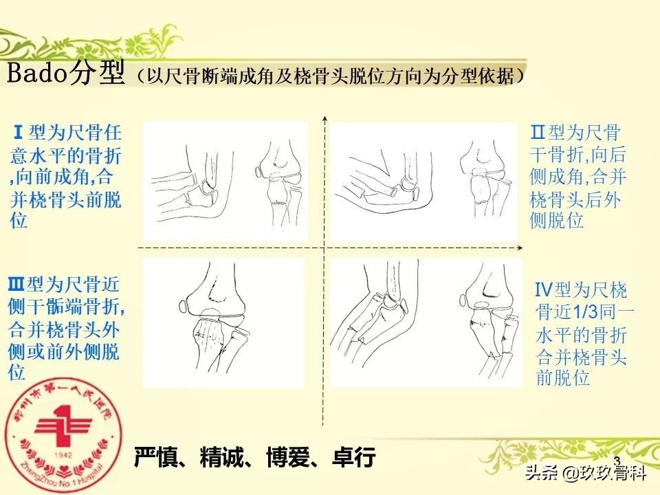 孟氏骨折功能训练多久能恢复正常,孟氏骨折中医能治吗