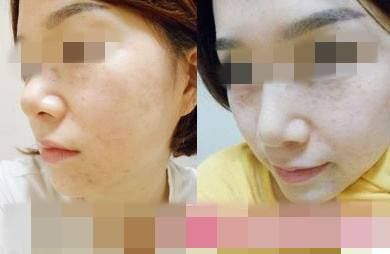 脸部微整形的危害,脸部微整形有什么危害