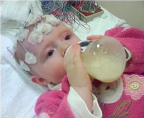 生酮治疗婴儿痉挛症有效吗,约翰霍普金斯医学院怎样