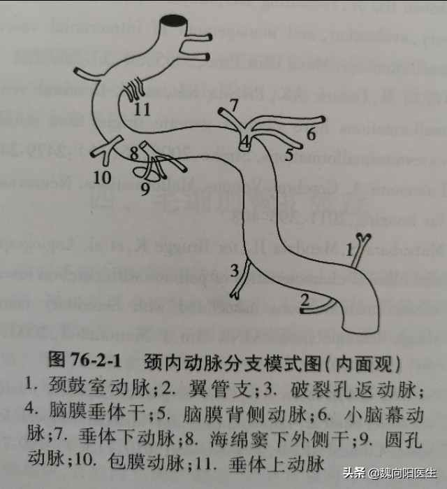 颈动脉海绵窦瘘症状,颈动脉海绵窦瘘介入需要多少钱