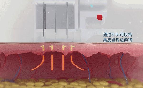 水光针是什么打了有什么作用,水光针如果停了会有什么影响