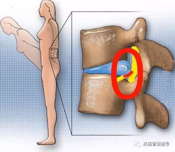 72岁老人腰疼还有骨刺该怎么治疗,老年人骨刺疼痛怎么治疗