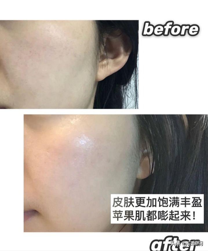 乱用水杨酸怎么办,用水杨酸软膏有危害吗