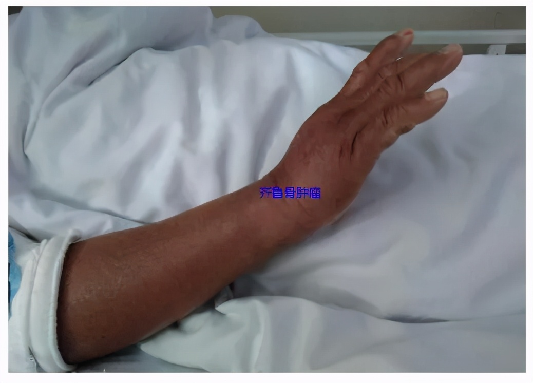 山东齐鲁医院青岛院区射频消融术,齐鲁医院等离子消融术